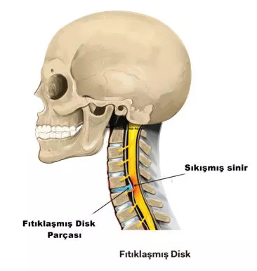 boyun fitigi doc dr ogr uyesi soner civi